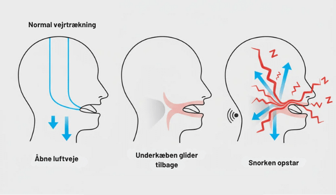 2 1 - Tusindvis af par sover tæt igen uden snorken takket være dette mundstykke