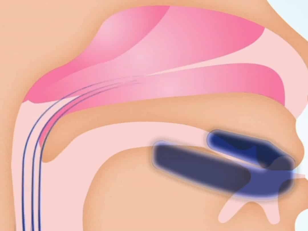 snore guard snorkeskinne edited - "Haveslange-effekten": Hvorfor du stadig snorker, selvom du ligger på siden (og det enkle trick, som løser det)